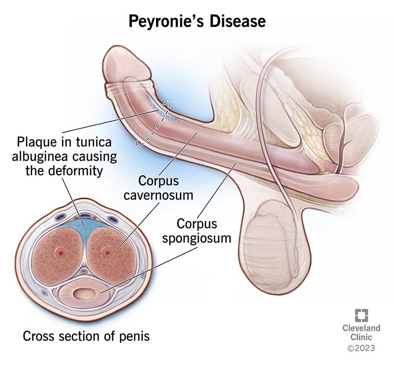 10044-peyronies-disease